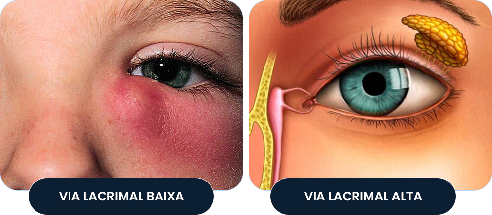 Comparação entre obstrução de via lacrimal baixa e alta
